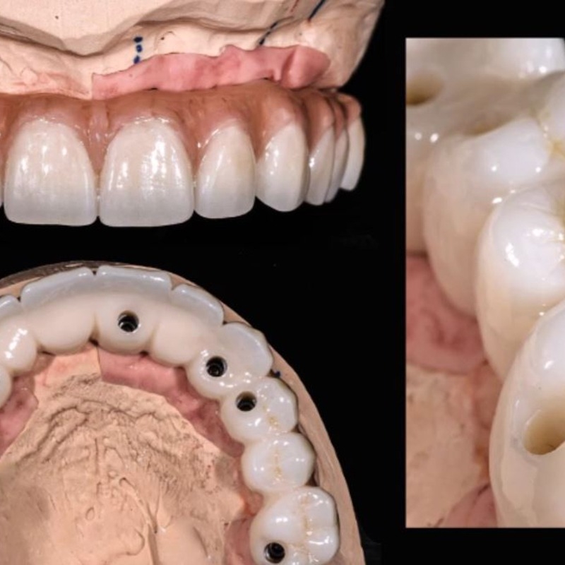 Triad Dental Studio Prosthesis